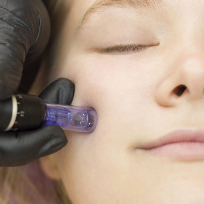 Microneedling